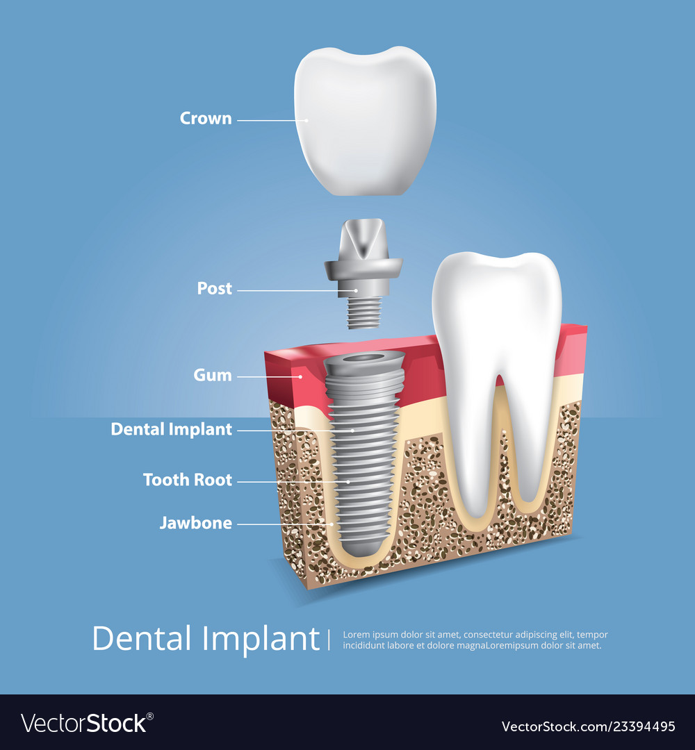 Human Teeth And Dental Implant Royalty Free Vector Image