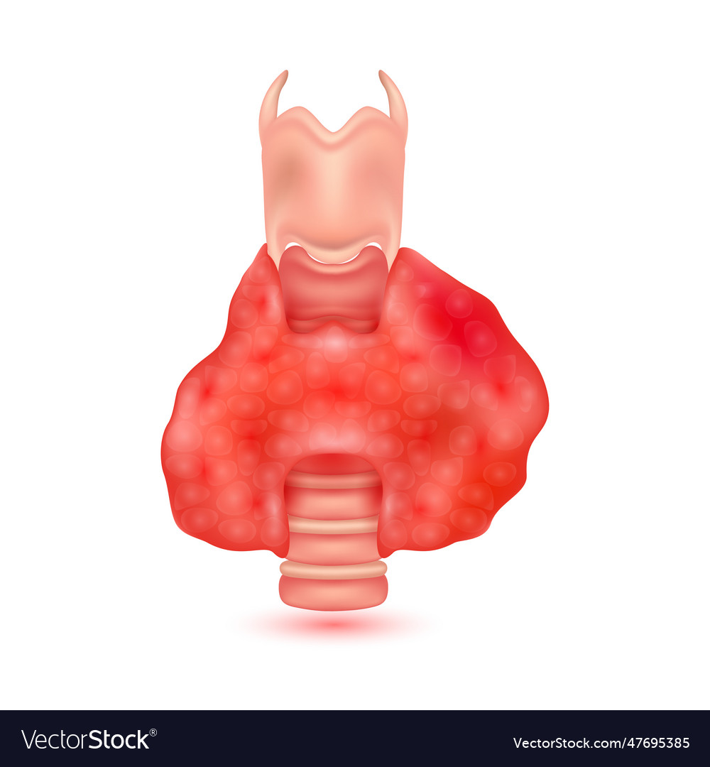 Hyperthyroidism Disease Human Thyroid Gland Vector Image