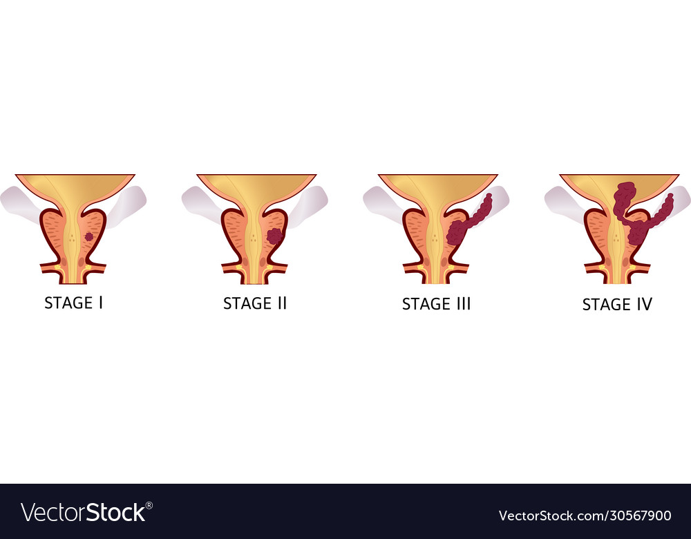 Stages Prostate Cancer From I To Iv Tumor Vector Image