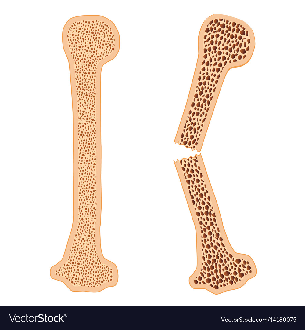 osteoporosis fracture recovery