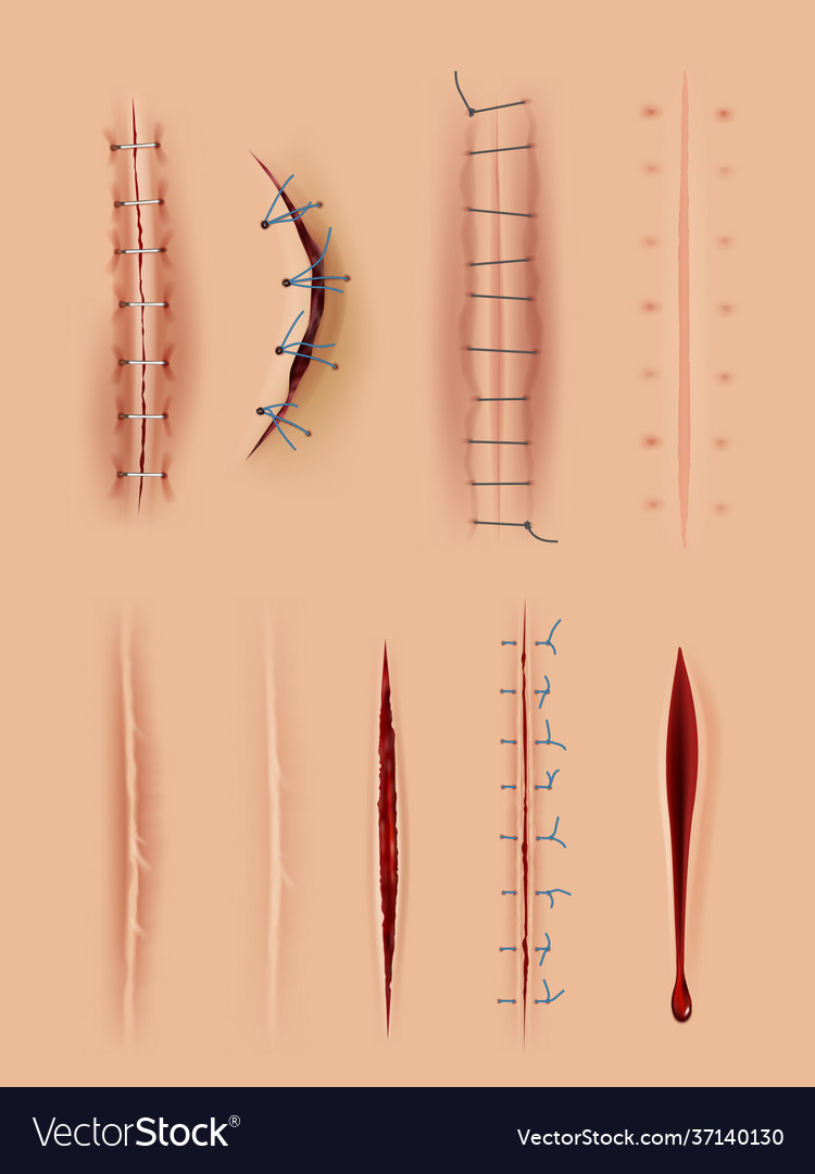 Realistic scars medical surgical sutures wounds Vector Image