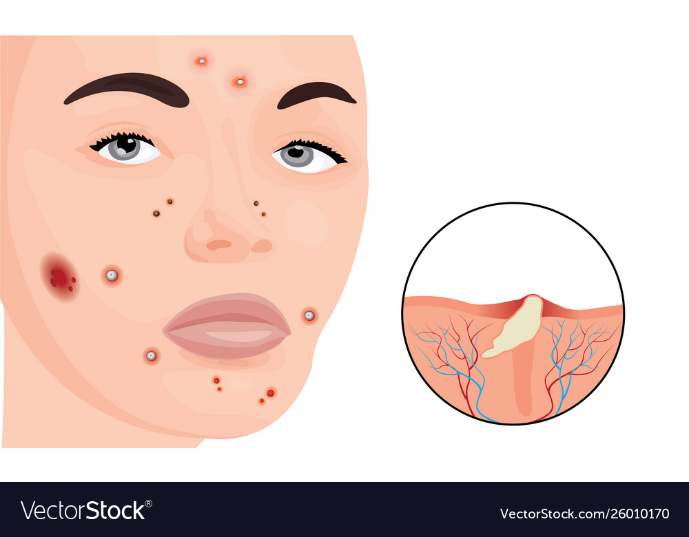 Acne on a woman face Royalty Free Vector Image