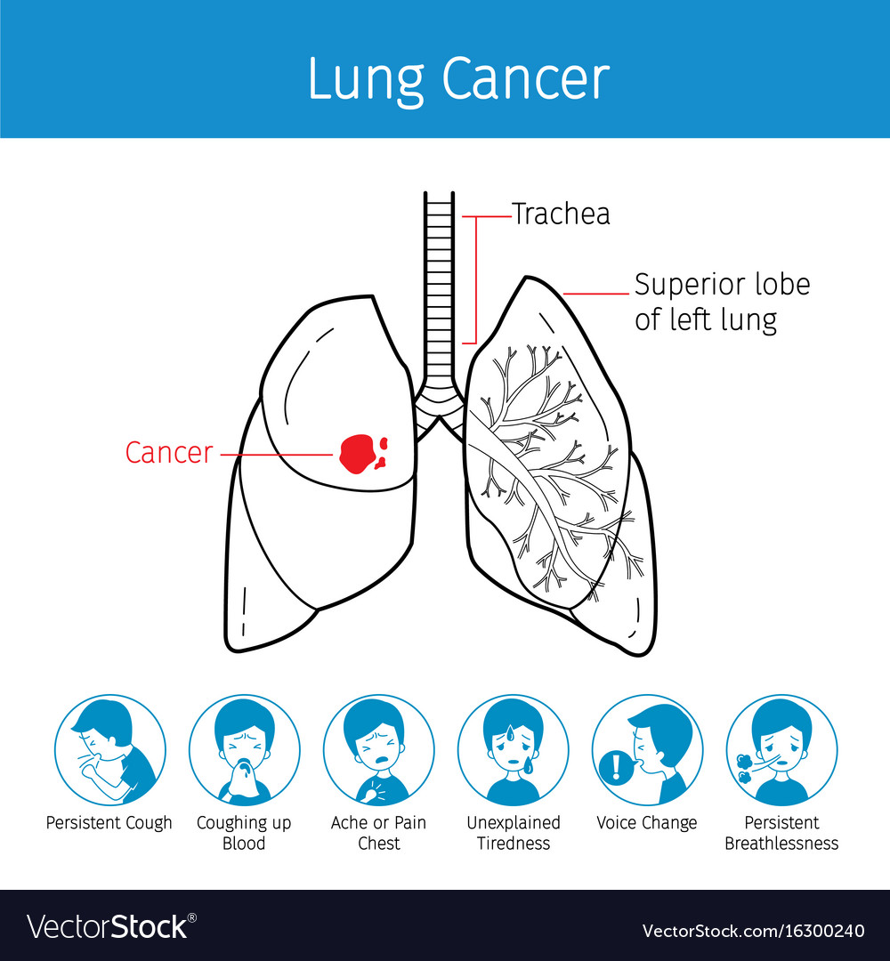 Nursing Pathophysiology Of Lung Cancer Diagram