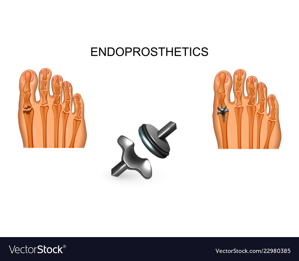 Big toe joint replacement Royalty Free Vector Image