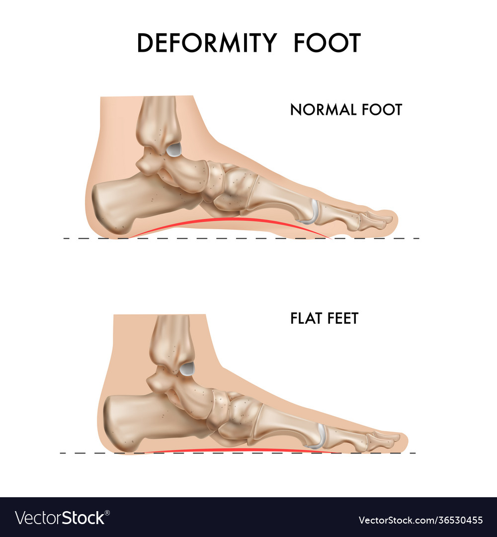 Foot bones deformation composition Royalty Free Vector Image