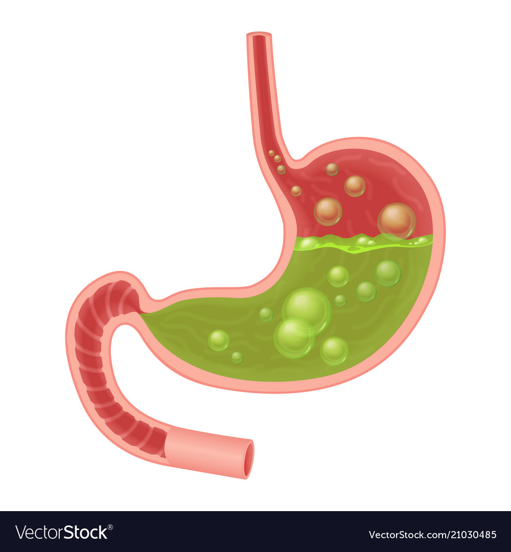Realistic medical of nausea stomach Royalty Free Vector