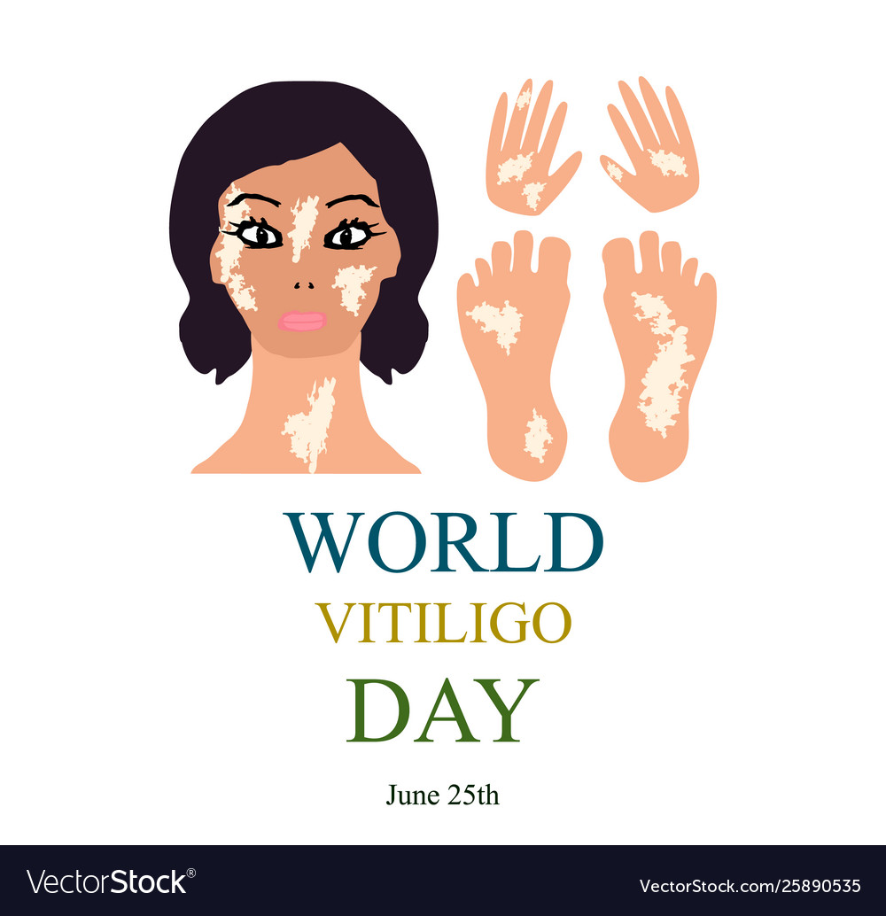 World vitiligo day infographics