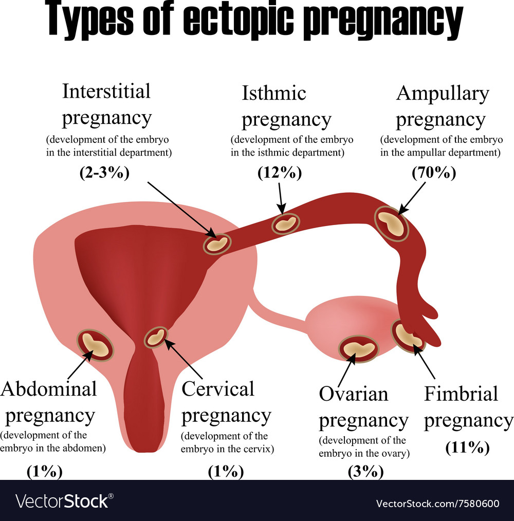 Types of ectopic pregnancy Infographics Royalty Free Vector