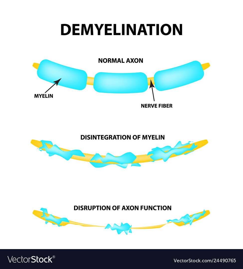 The destruction of the myelin sheath on the axon Vector Image