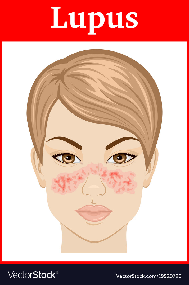 Lupus Royalty Free Vector Image - VectorStock