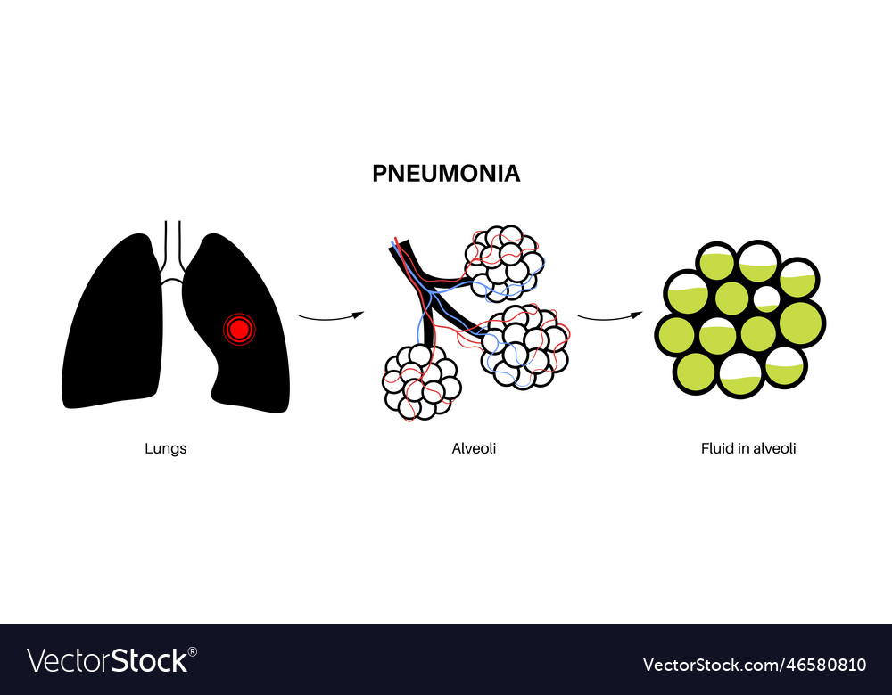 Pneumonia infection poster Royalty Free Vector Image