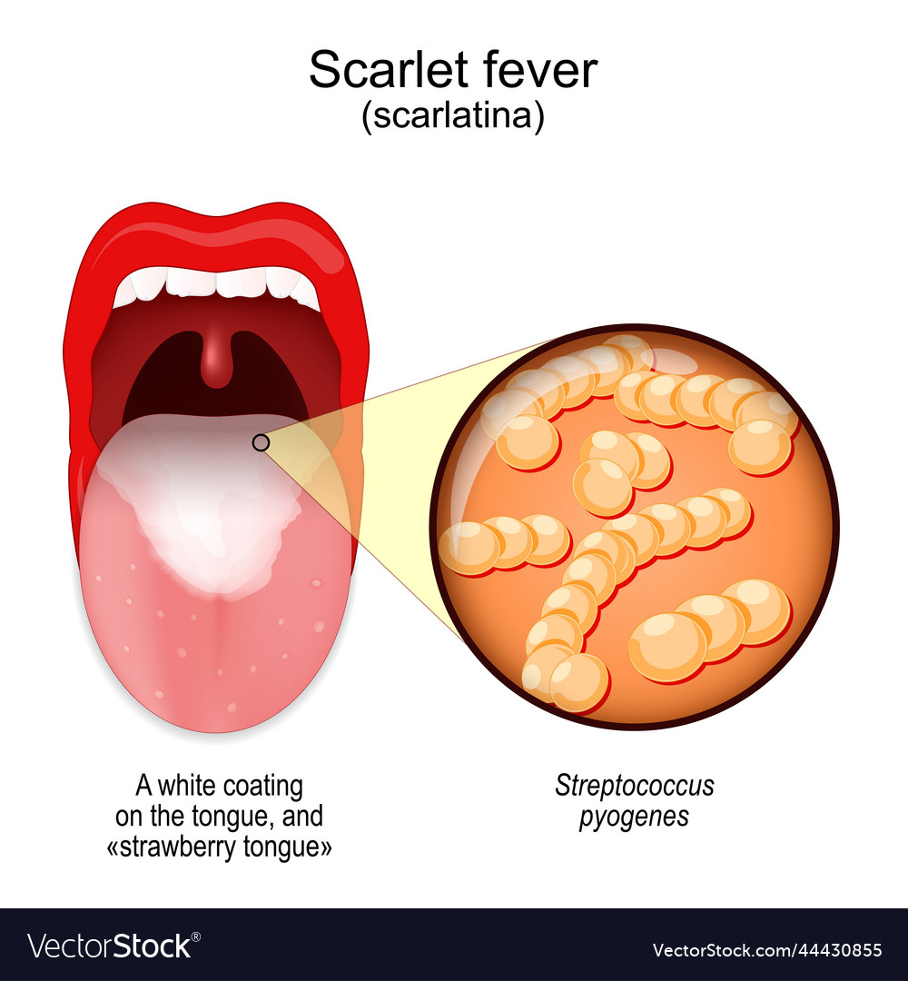 Scarlet fever mouth with symptoms of scarlatina Vector Image