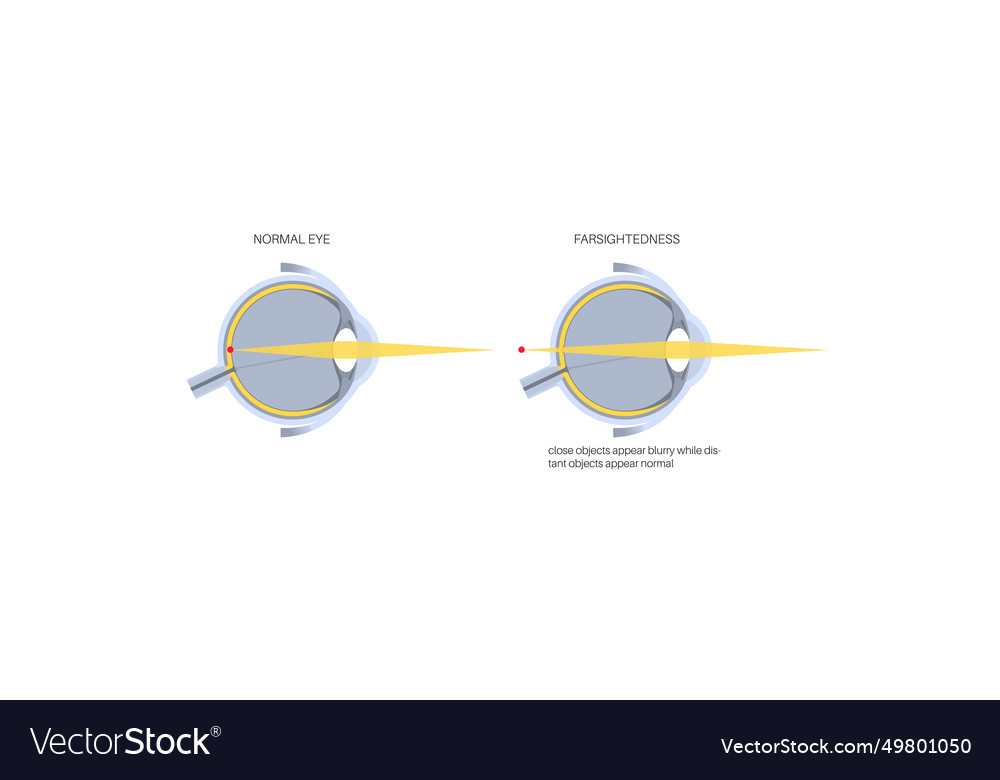 Normal eye and farsightedness Royalty Free Vector Image