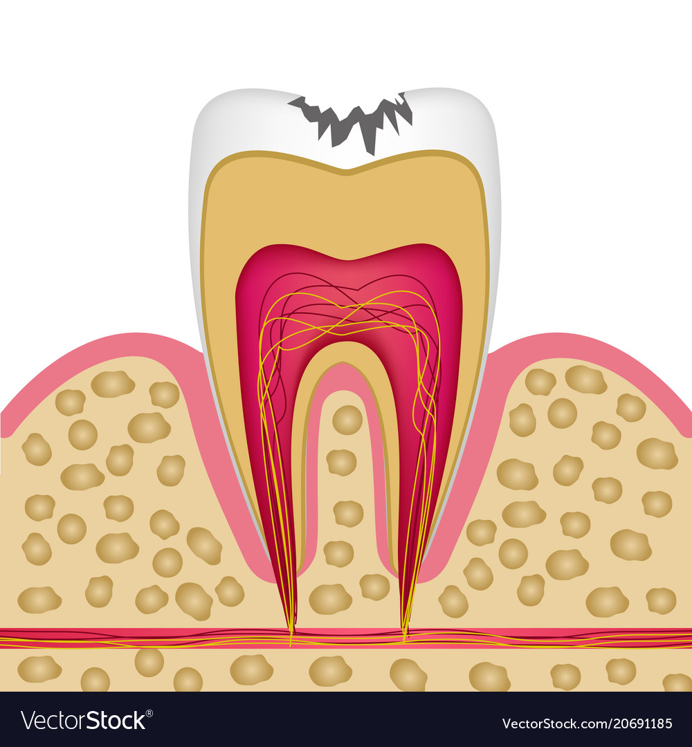 Tooth structure in cross section with caries to Vector Image