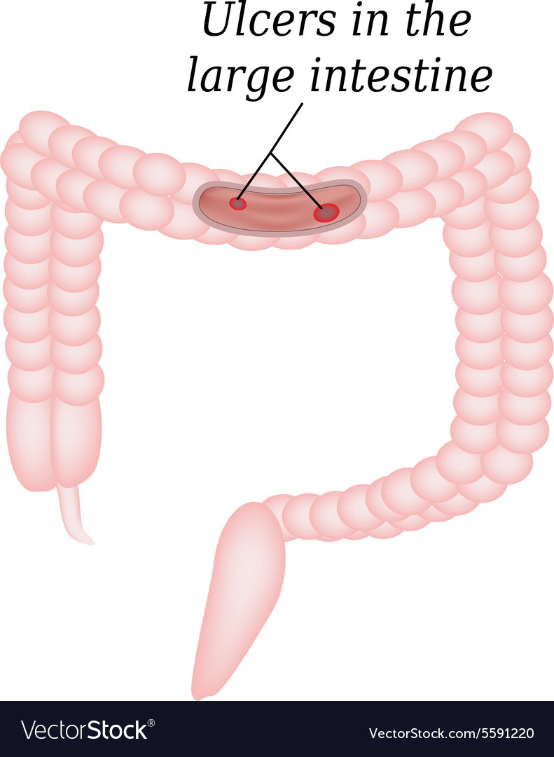 ulcer-in-the-intestine-ulcers-in-the-colon-vector-image