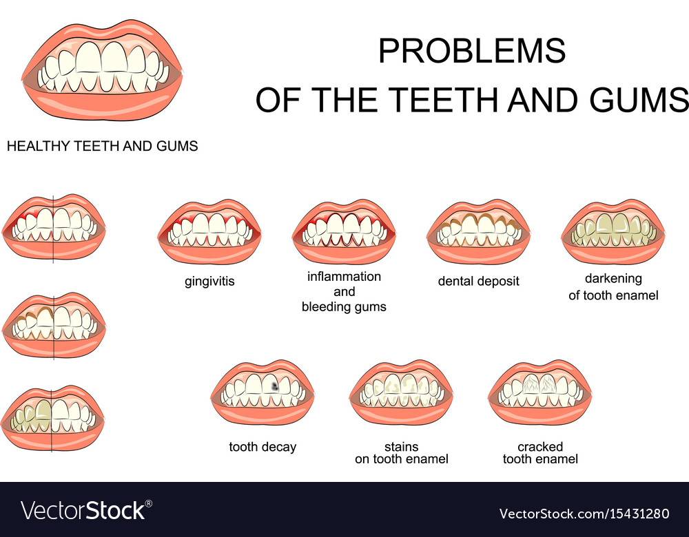 Problems of the teeth and gums Royalty Free Vector Image