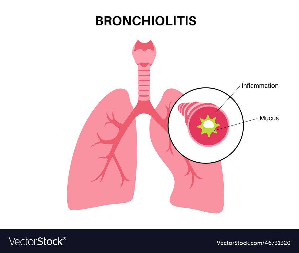 Bronchiolitis lung disease Royalty Free Vector Image