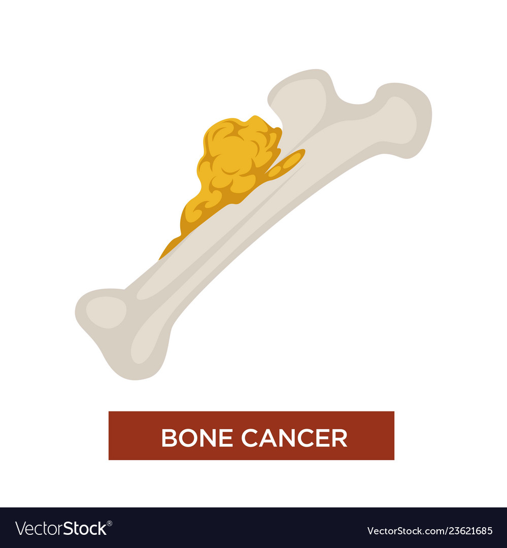 Bone cancer tumor and oncology marrow disease Vector Image Bone cancer tumor and oncology marrow disease Vector Image
