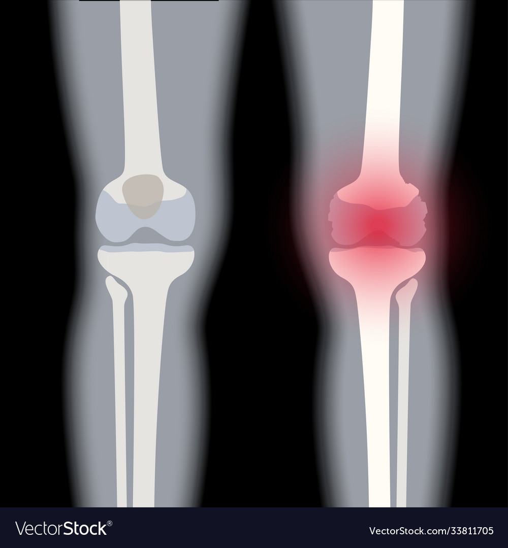 Arthritis in knee joint Royalty Free Vector Image