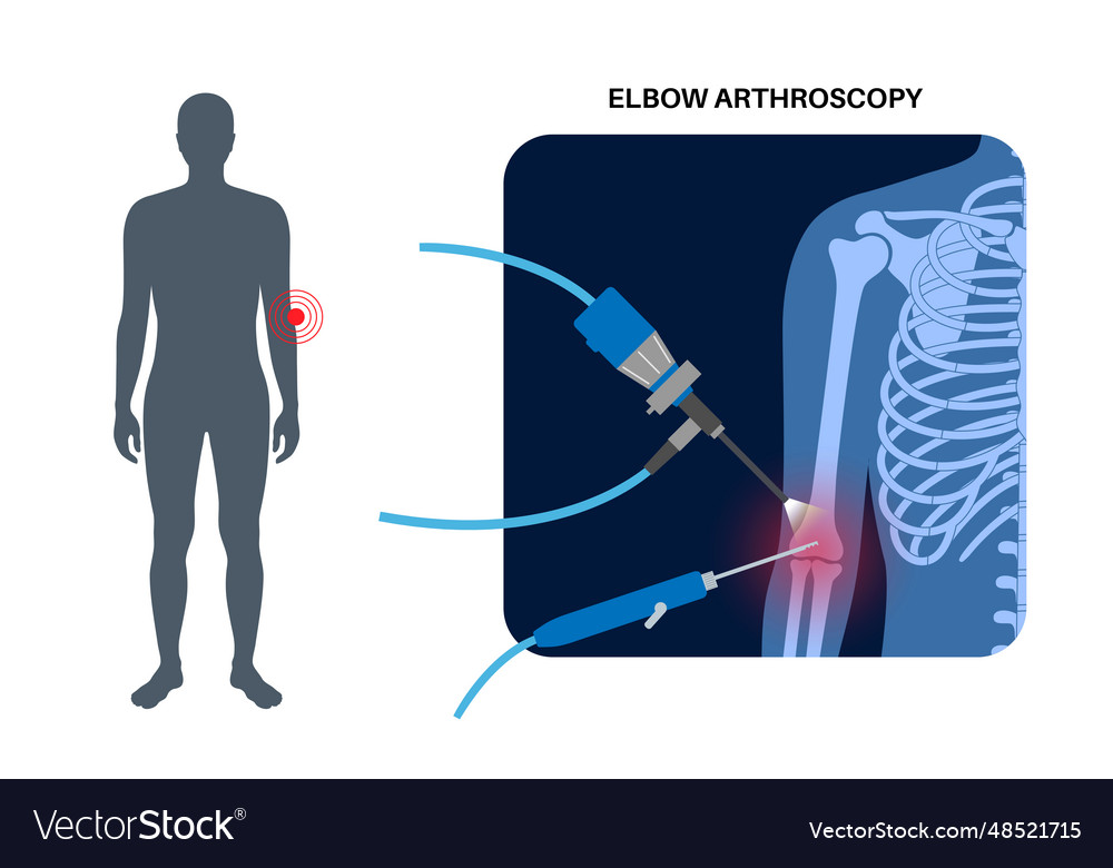 Elbow arthroscopy surgery Royalty Free Vector Image