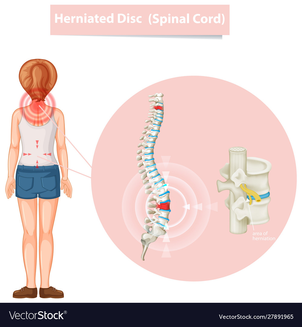 Diagram showing herniated disc Royalty Free Vector Image