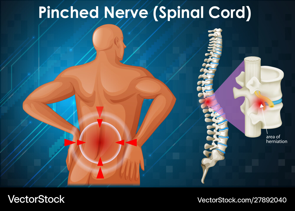 Diagram showing pinched nerve Royalty Free Vector Image