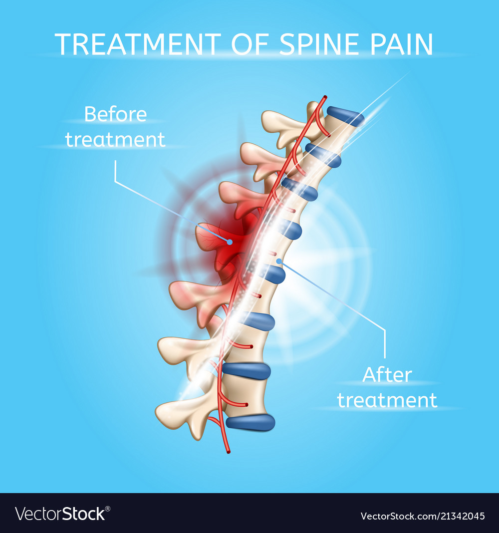 Spine Symptoms Chart