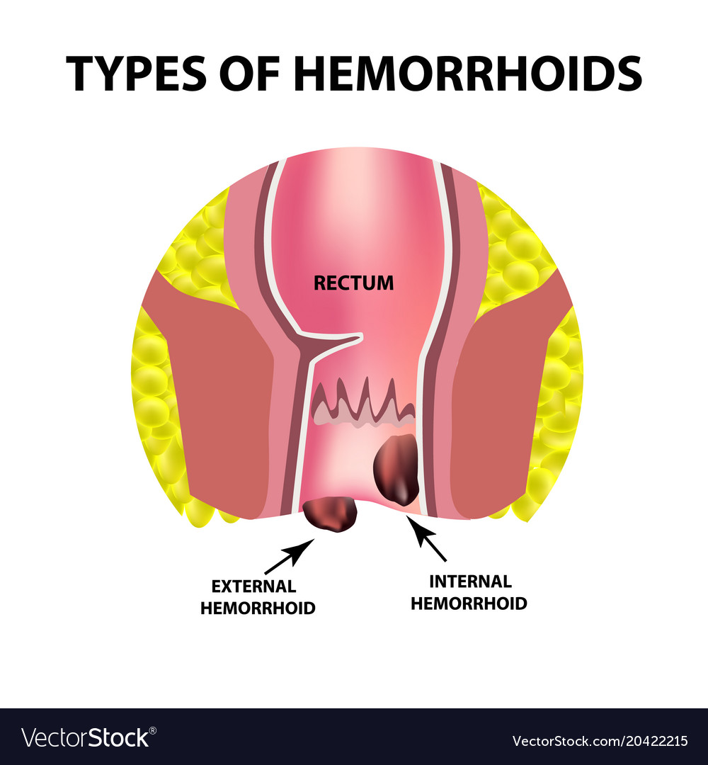 Two types of hemorrhoids are external and internal