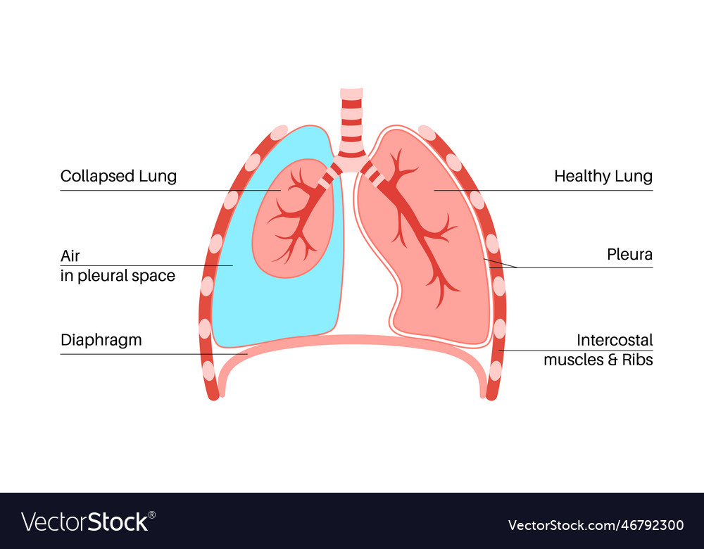 Pneumothorax anatomical poster Royalty Free Vector Image