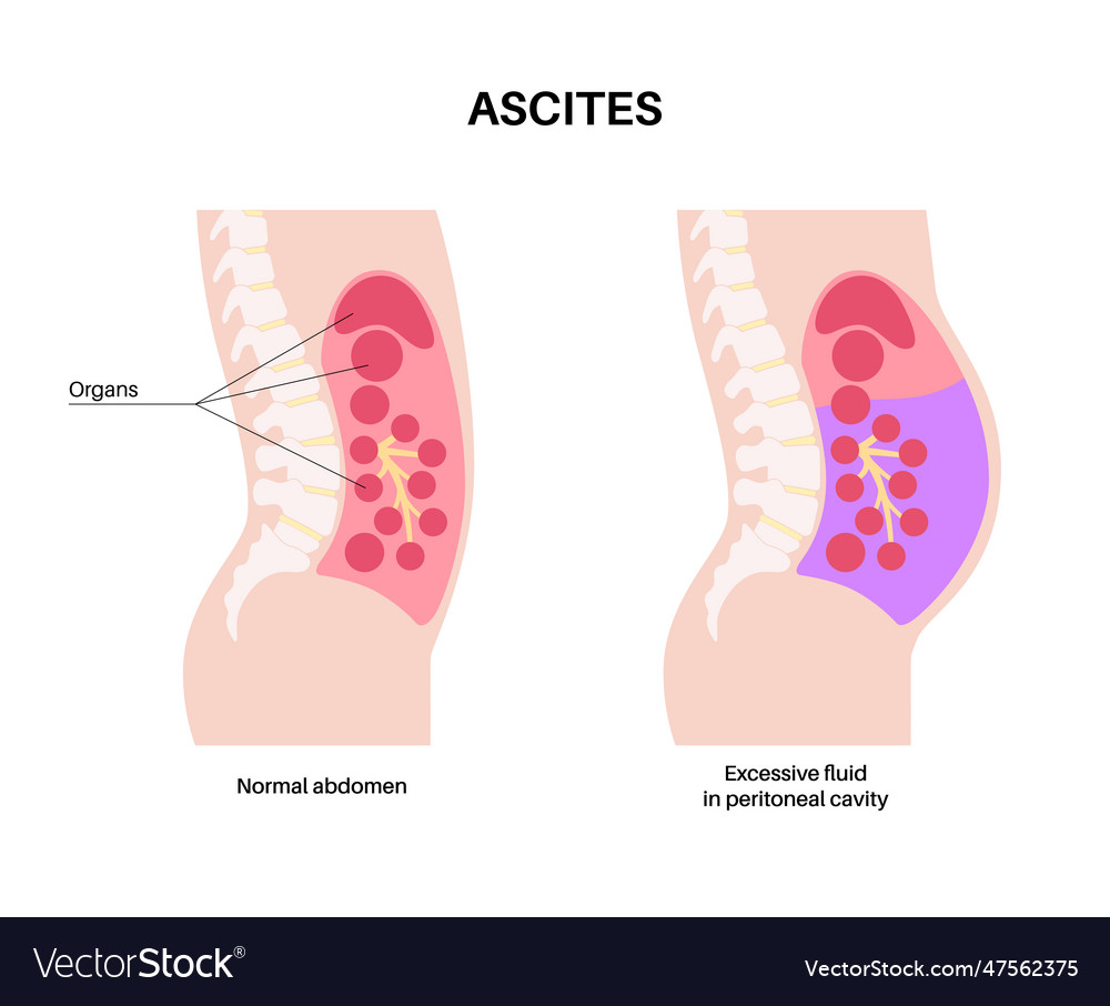 Ascites Disease Poster Royalty Free Vector Image