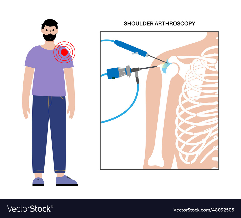 Shoulder arthroscopy poster Royalty Free Vector Image