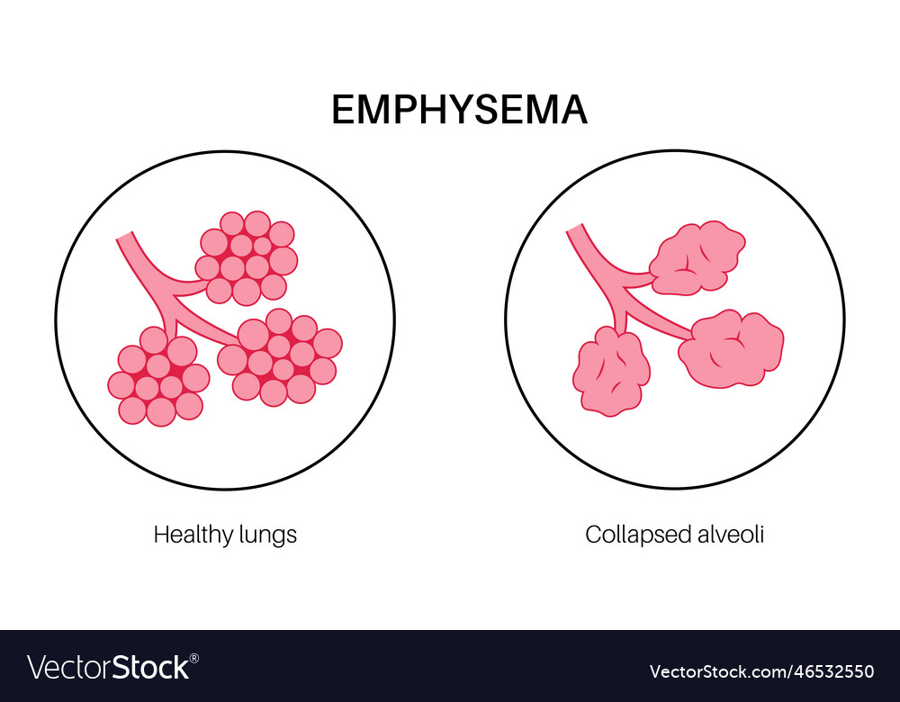 Emphysema anatomical poster Royalty Free Vector Image