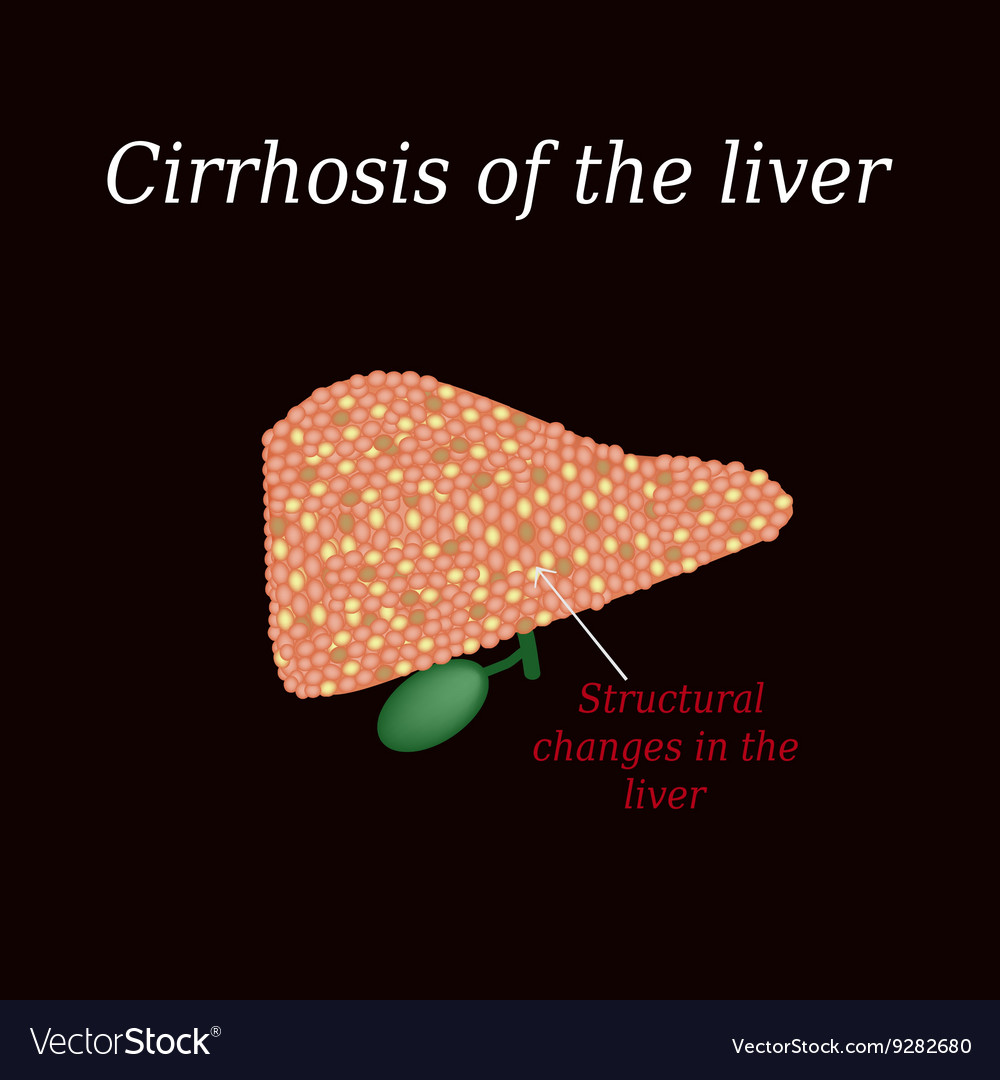 Cirrhosis of the liver