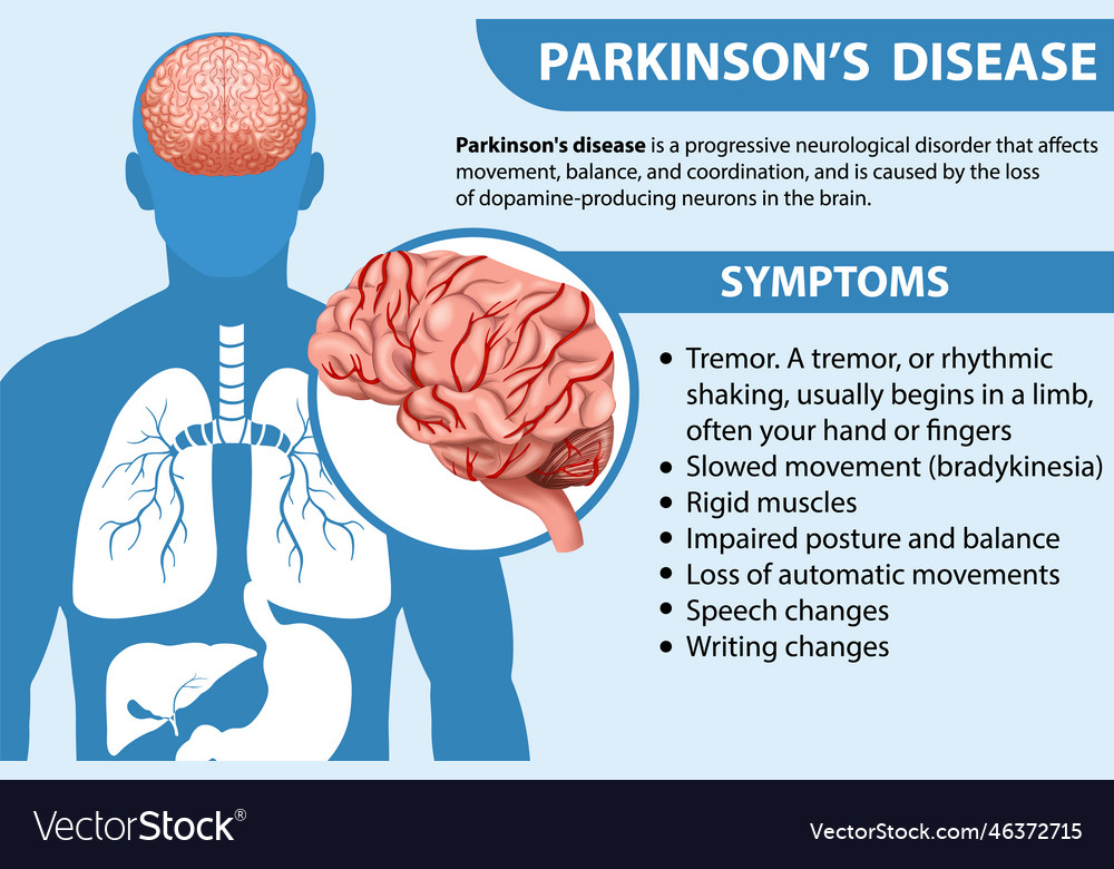 Informative poster of parkinson disease Royalty Free Vector