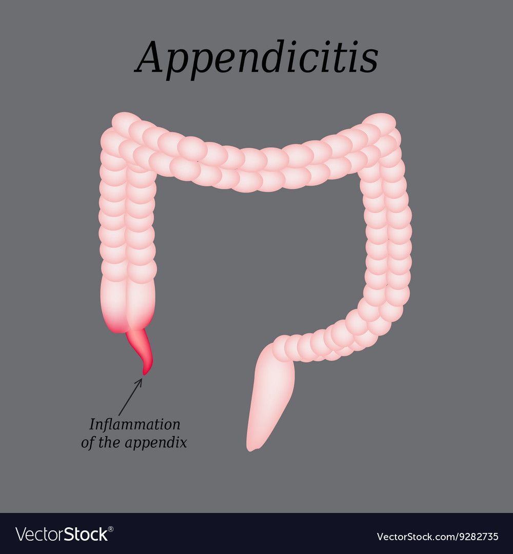 Appendicitis inflammation of the appendix colon Vector Image