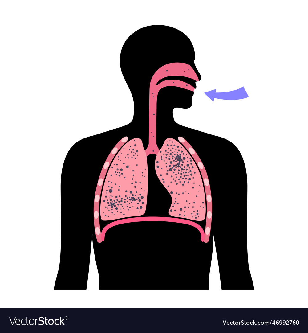 Pneumoconiosis lung disease Royalty Free Vector Image