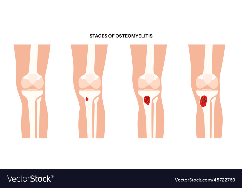 Tibia bone osteomyelitis