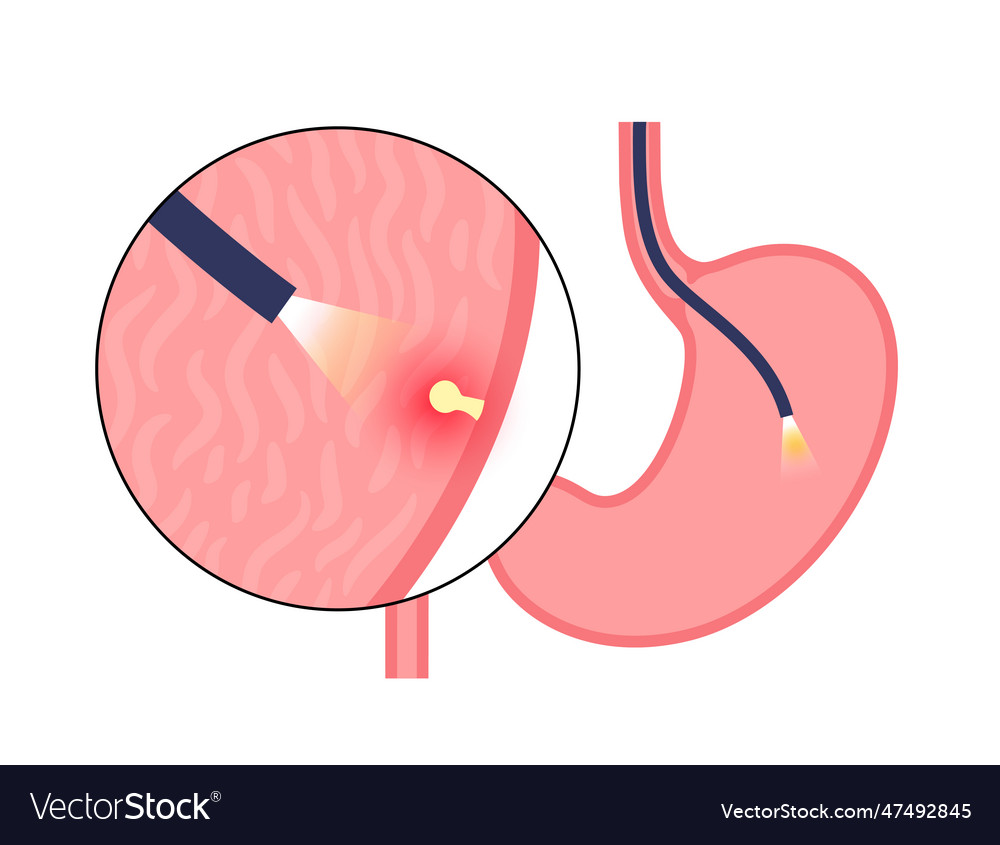 Gastroscopy Endoscopy Procedure Royalty Free Vector Image