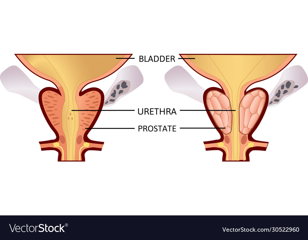 Benign prostatic hyperplasia prostatitis