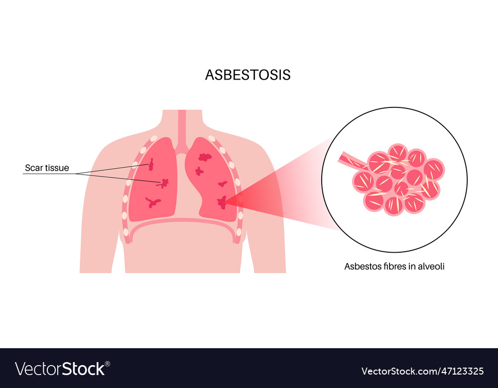 Asbestosis lung disease