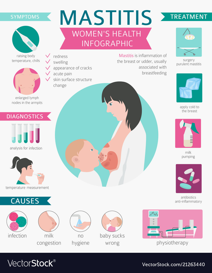 Mastitis breastfeed medical infographic Royalty Free Vector