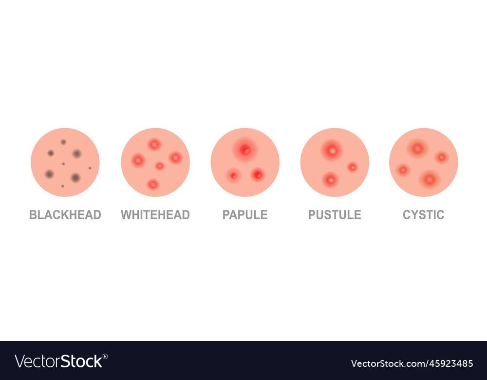 Types Of Acne Skincare Problems And Inflammation Vector Image