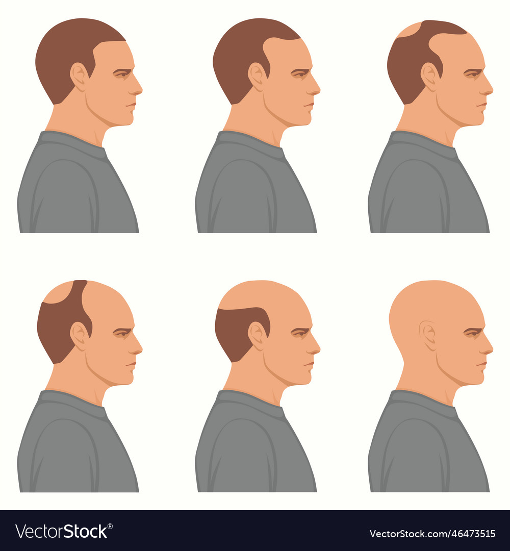 Hair loss stages isolated male alopecia Royalty Free Vector