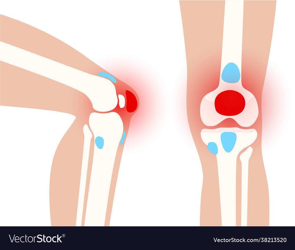 Bursitis Inflammation Concept Royalty Free Vector Image