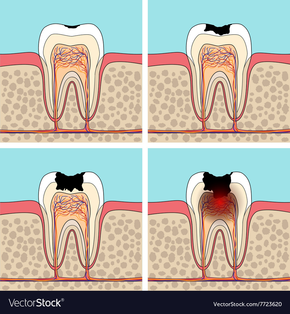 Stages Of Development Of Dental Caries Vector Stock Vector Image My 