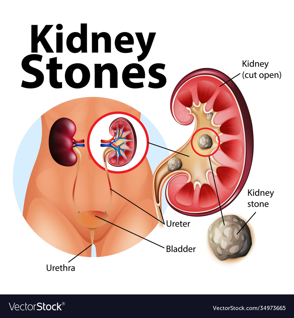 Informative kidney stones