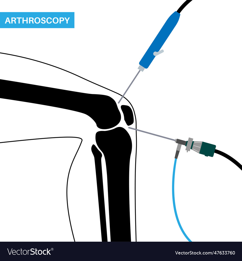 Knee joint arthroscopy Royalty Free Vector Image