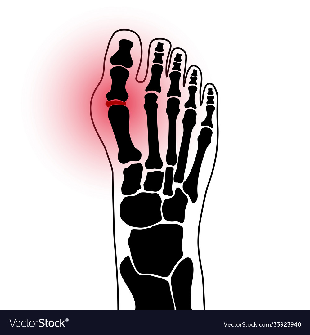 Arthritis foot concept Royalty Free Vector Image