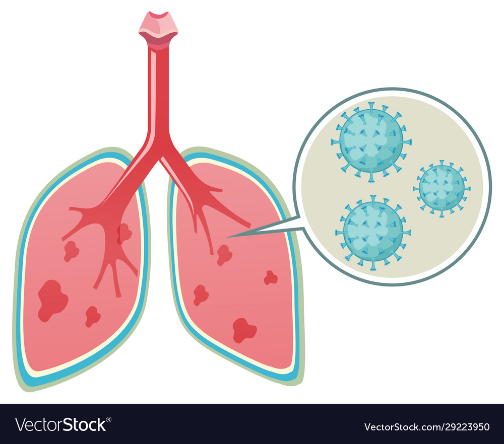 Diagram Showing Virus In Human Lungs On White Vector Image