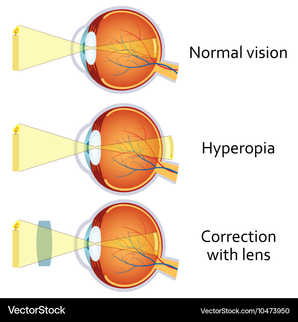 Hyperopia corrected by a plus lens Royalty Free Vector Image